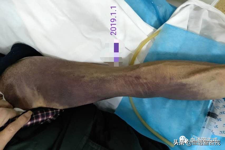 内瘘穿刺血肿的处理方式,皮下血肿穿刺抽吸后又出怎么办