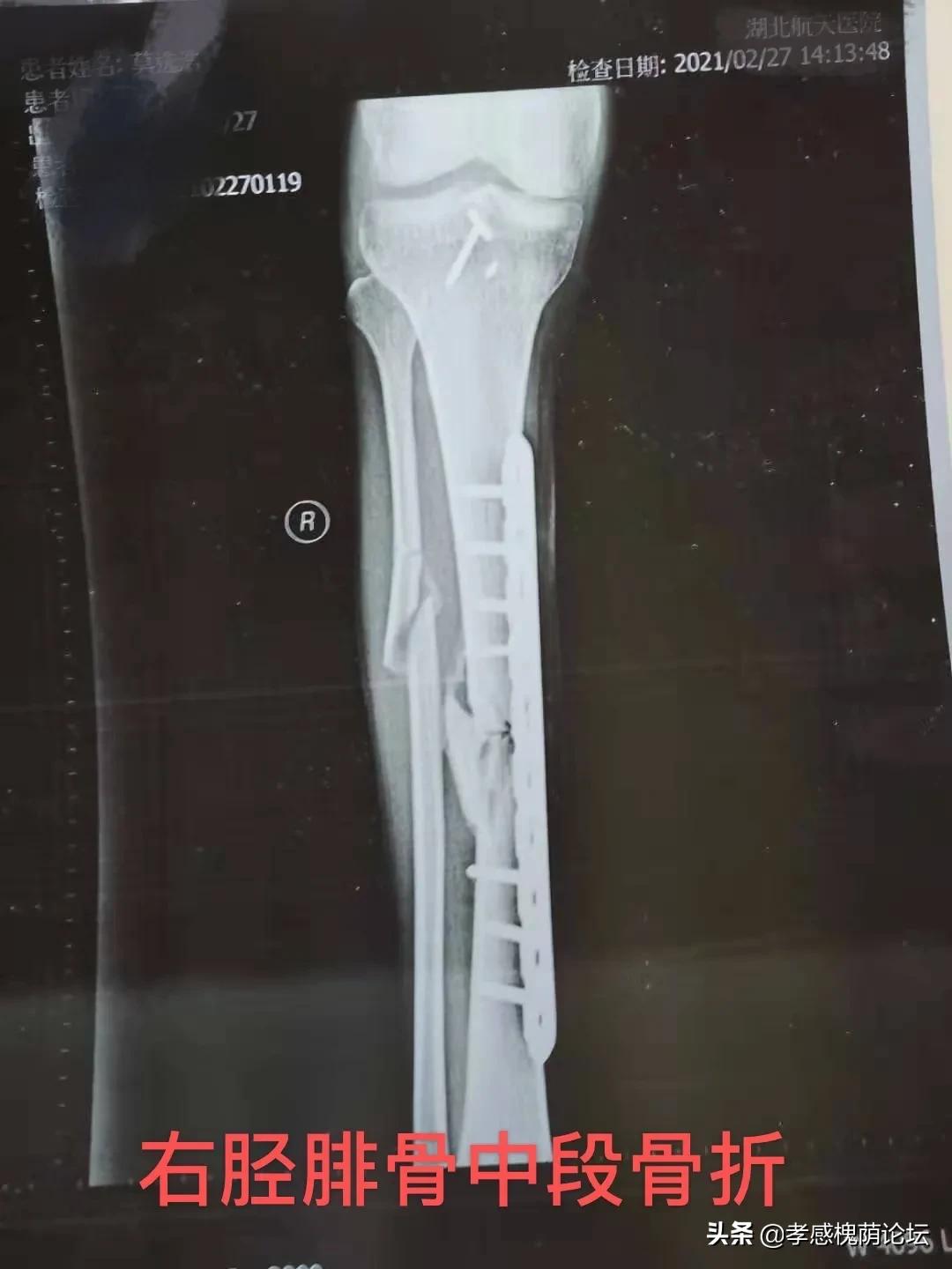 伤筋动骨一百天是对的吗,伤筋动骨一百天真的不能动吗