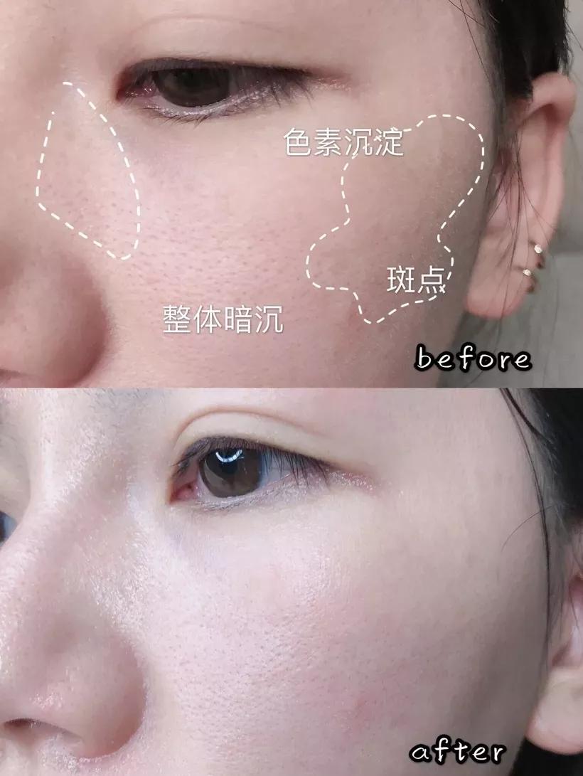 2块钱的它、竟然能亮白、祛痘印、淡斑！？太神奇了！
