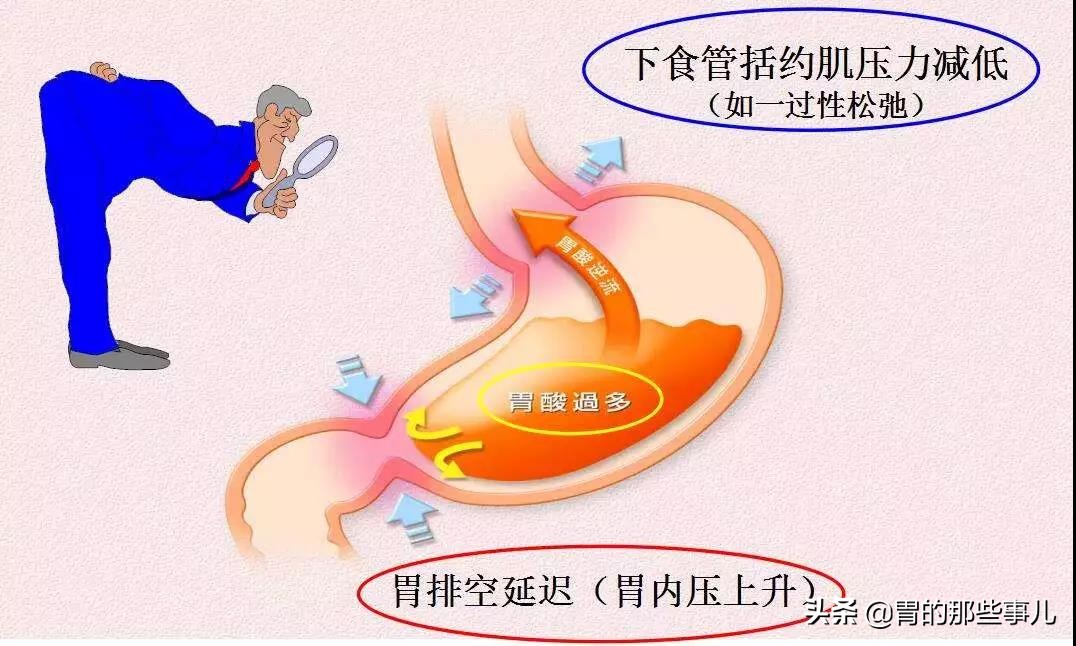 慢性咽炎胃酸反流吃什么药,食管反流引起的咽炎怎么抑制胃酸