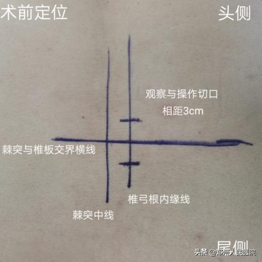 对骨科微创技术的认识,骨科手术与保守治疗对比