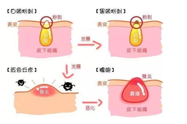 闭口痘痘就要一直涂闭口的药吗,脸上长闭口真闭口和假闭口