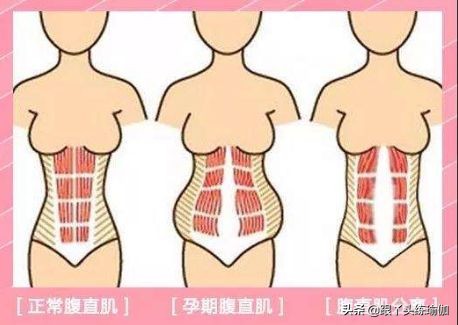 产后腹直肌很松怎么办,产后腹直肌分离恢复瘦肚子训练