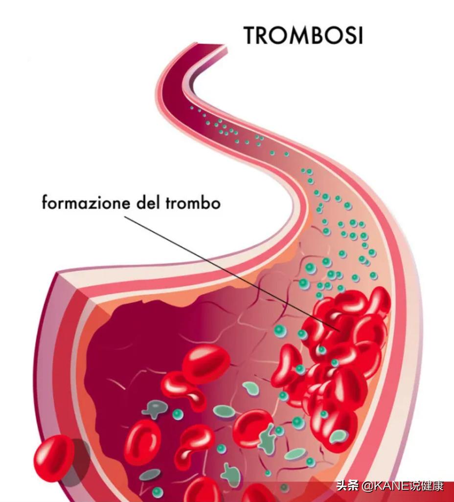 血液净化能控制血栓吗,血液净化真的能排油吗