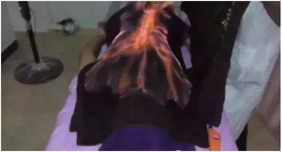 吓skr人！“火烤活人”可以治病？这种火疗很危险，谨慎玩火*焚自**！