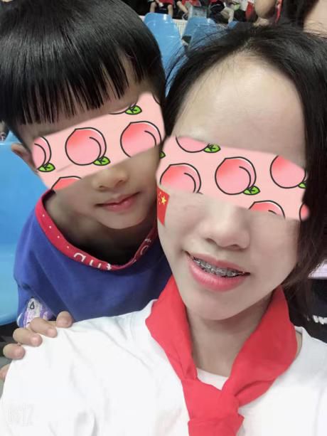 有兔牙如何改善,兔牙怎么矫正