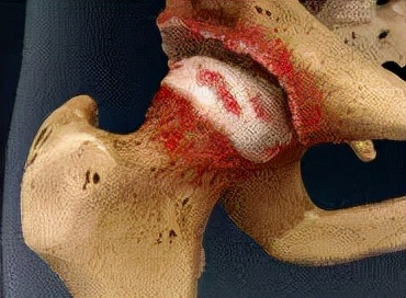 股骨头坏死和腰间盘突出症状区别,椎间盘突出和股骨头坏死症状区别