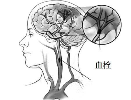 脑梗和叶酸有什么关系,脑梗除了吃叶酸外还要做好三件事