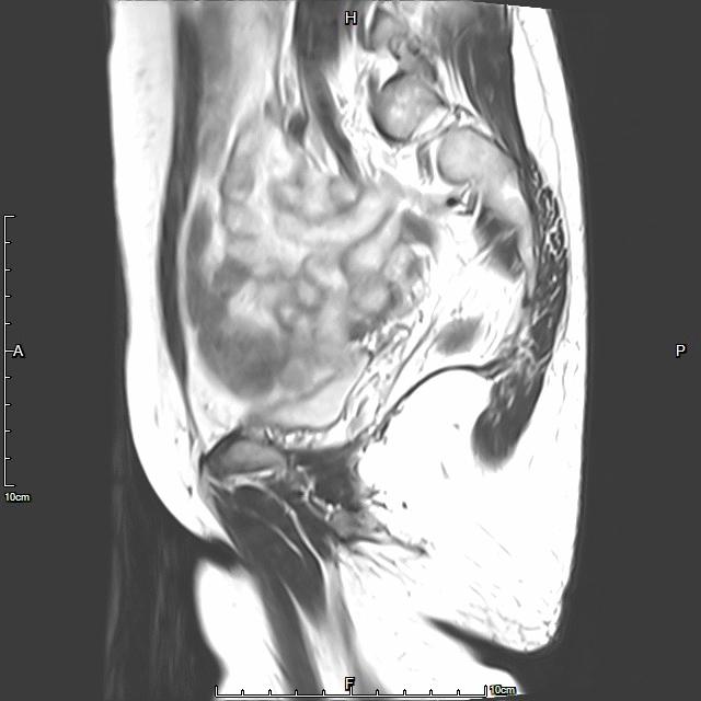 子宫腺肌症称为不死的癌症,子宫腺肌症是不死的癌症吗