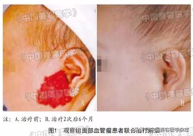 脉冲染料激光和光子嫩肤效果,脉冲染料激光能治斑吗