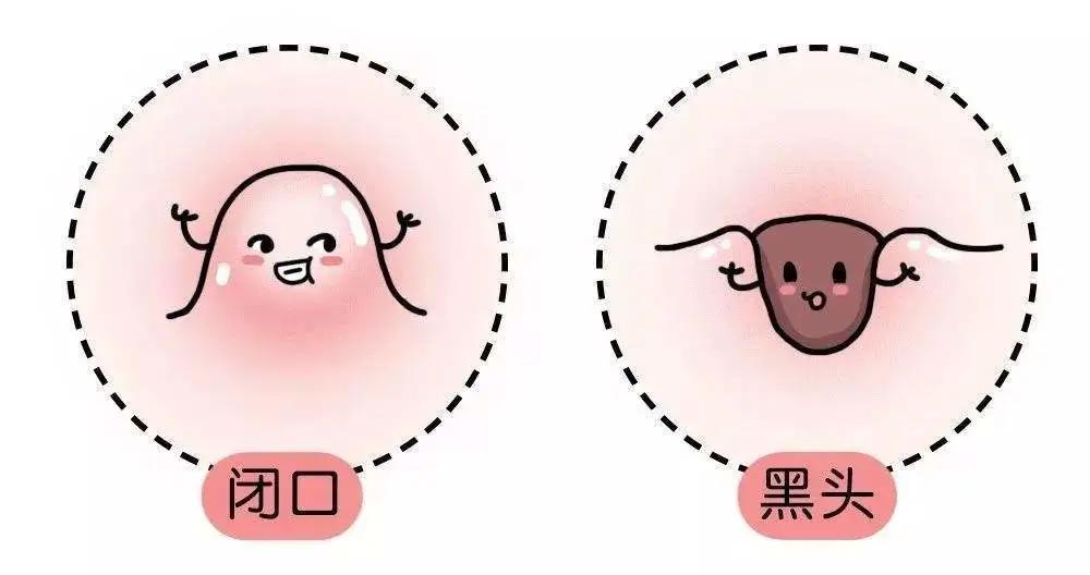 如何正确有效的去粉刺,消除粉刺的正确有效方法