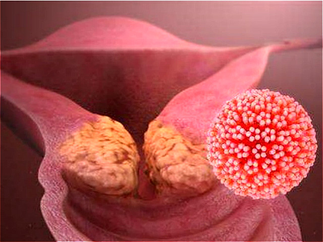 妇科疾病hpv感染怎么办,hpv感染就是妇科疾病吗