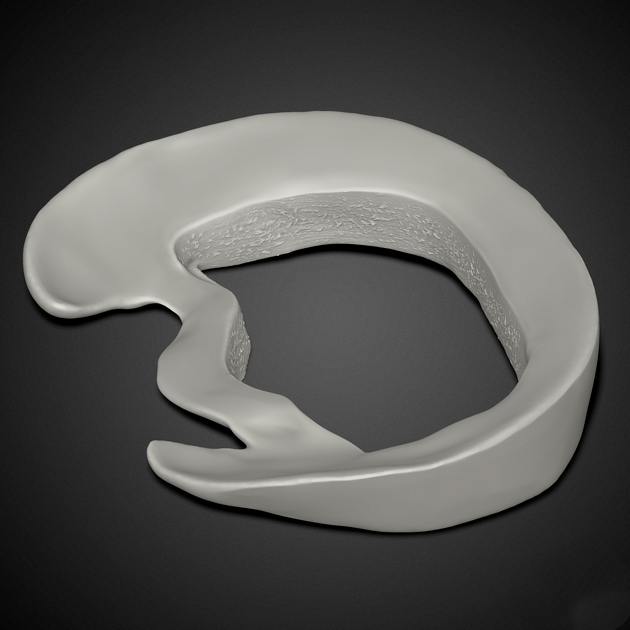 半月板撕裂手术后会有哪些症状,半月板撕裂时间长了可以做手术吗