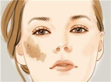 怎么区分脸上是什么斑,脸上斑怎么区分