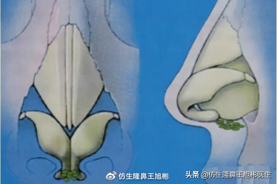 隆鼻鼻型科普,鼻基底凹陷隆鼻可以改善吗