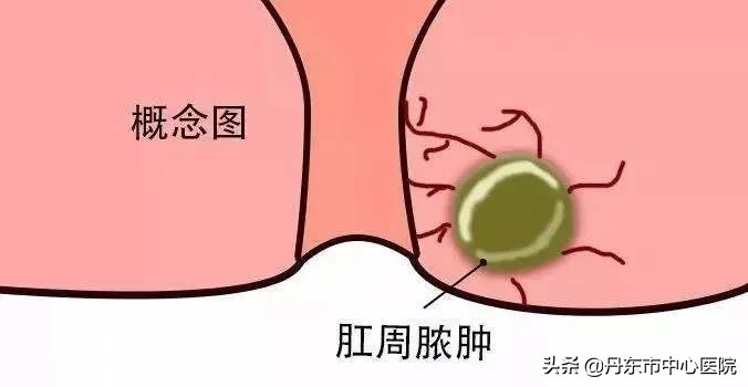 肛周脓肿最佳治愈方法,肛周脓肿和火疖子区别