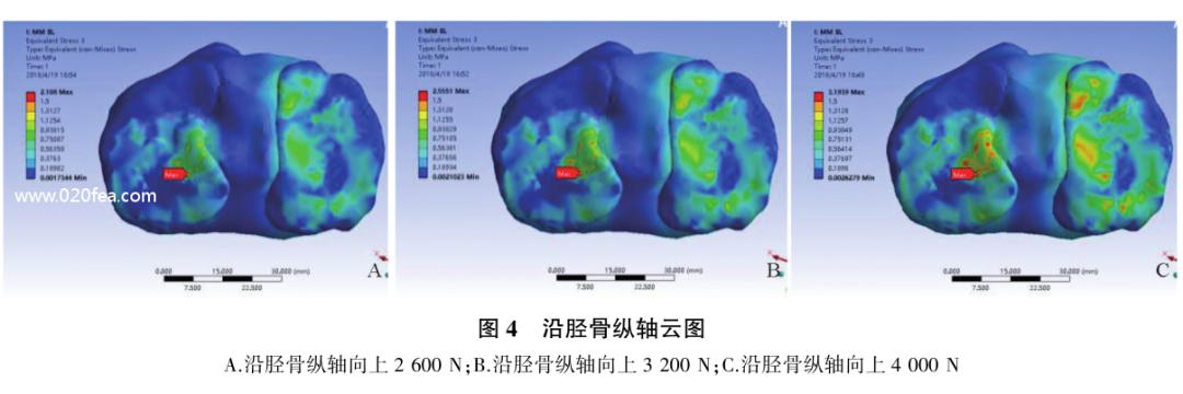 半月板后角二度真实模型,内侧半月板后角结构图