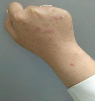 银屑病被误诊为神经性皮炎,刚发现银屑病能治好吗