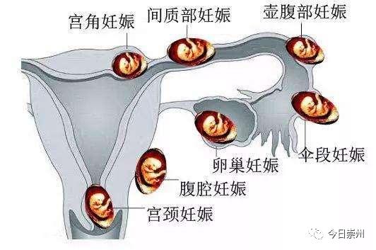协和妇科宫外孕,崇州市妇幼保健院医疗事故