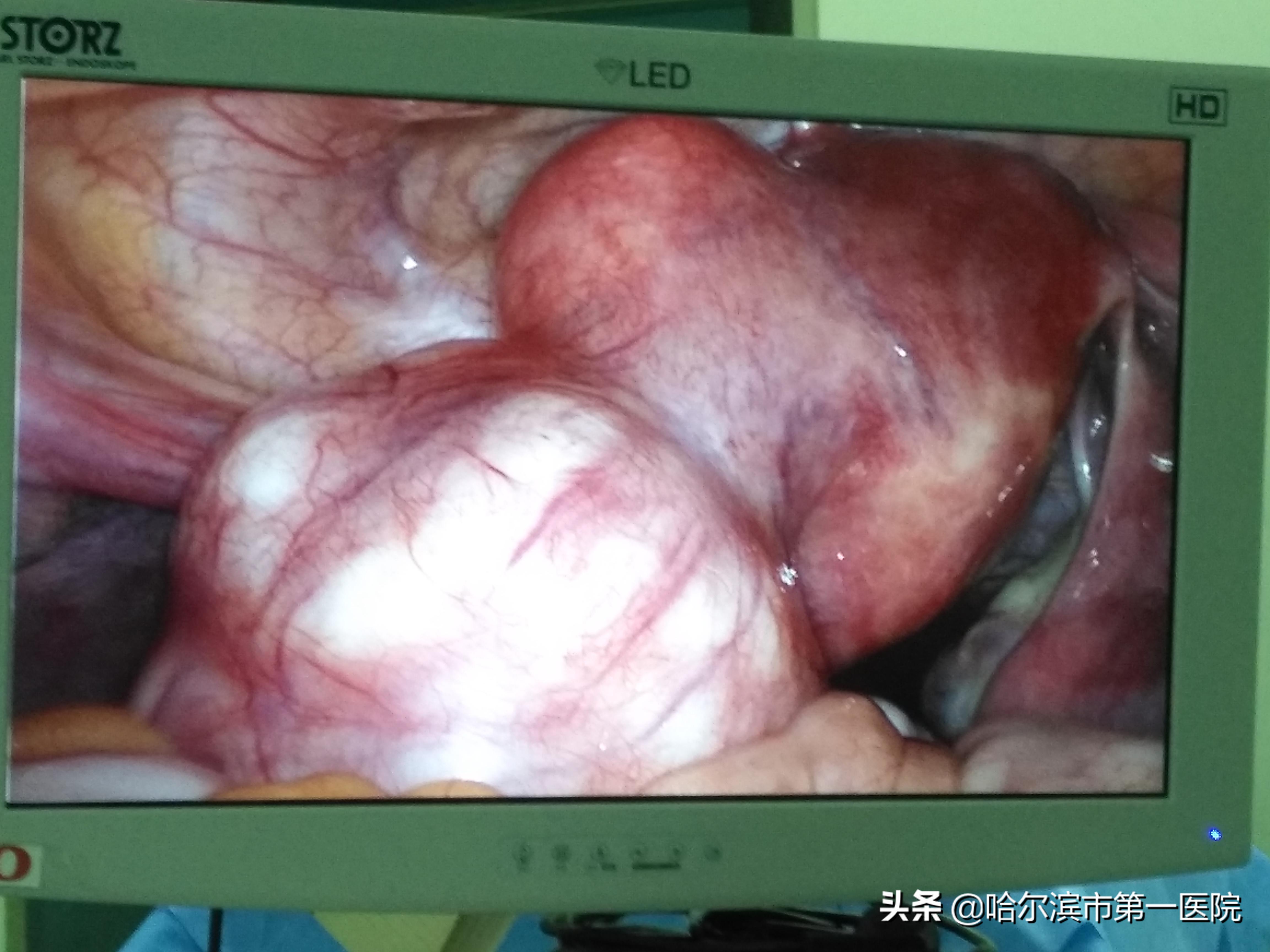 未婚女多发子宫肌瘤恐术后留疤市一院微创单孔腔镜核除解烦忧