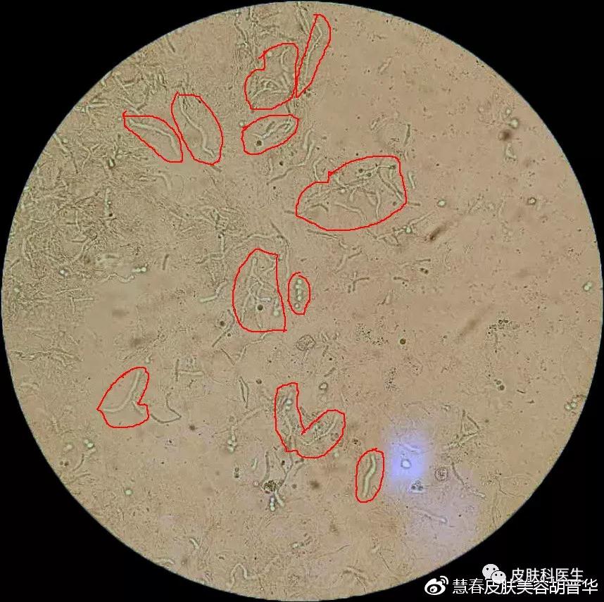 是不是皮肤癣，皮肤真菌镜检来告诉你！
