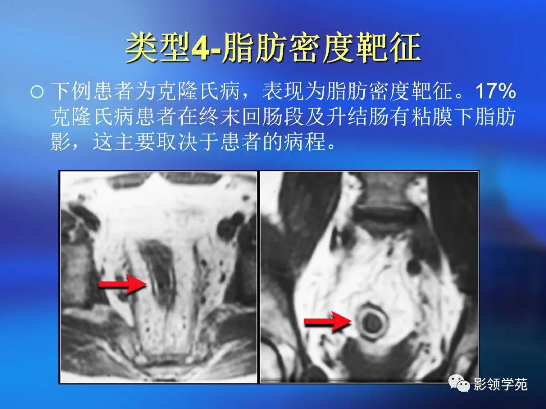 肠道内壁增厚,肠道扩张ct表现