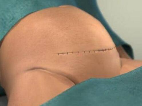 疤痕体质孕妇要关注什么,疤痕体质孕妇剖腹产后疤痕什么样