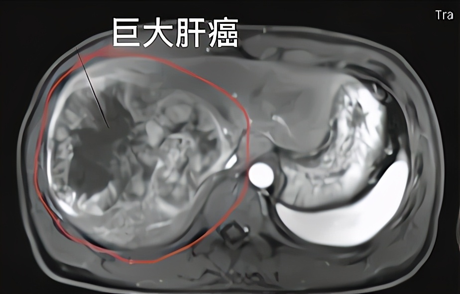 丙肝致肝癌的三大危险,有乙肝丙肝是不是容易得肝癌