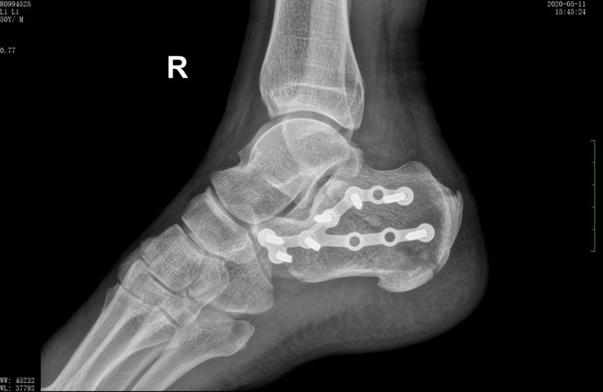左股骨粗隆间粉碎性骨折微创手术,跟骨粉碎性骨折微创手术最快多久