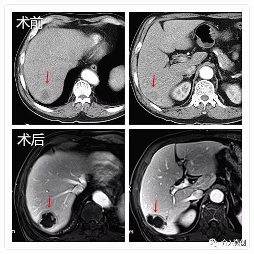 栓塞介入能治疗肝转移瘤吗,结肠癌肝转移介入栓塞治疗