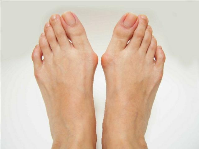 拇外翻大脚趾疼如何在家就能治,大脚拇指痛要警惕