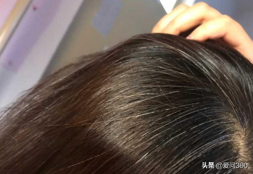 头发白严重怎么补救,头发白是什么原因怎么改善
