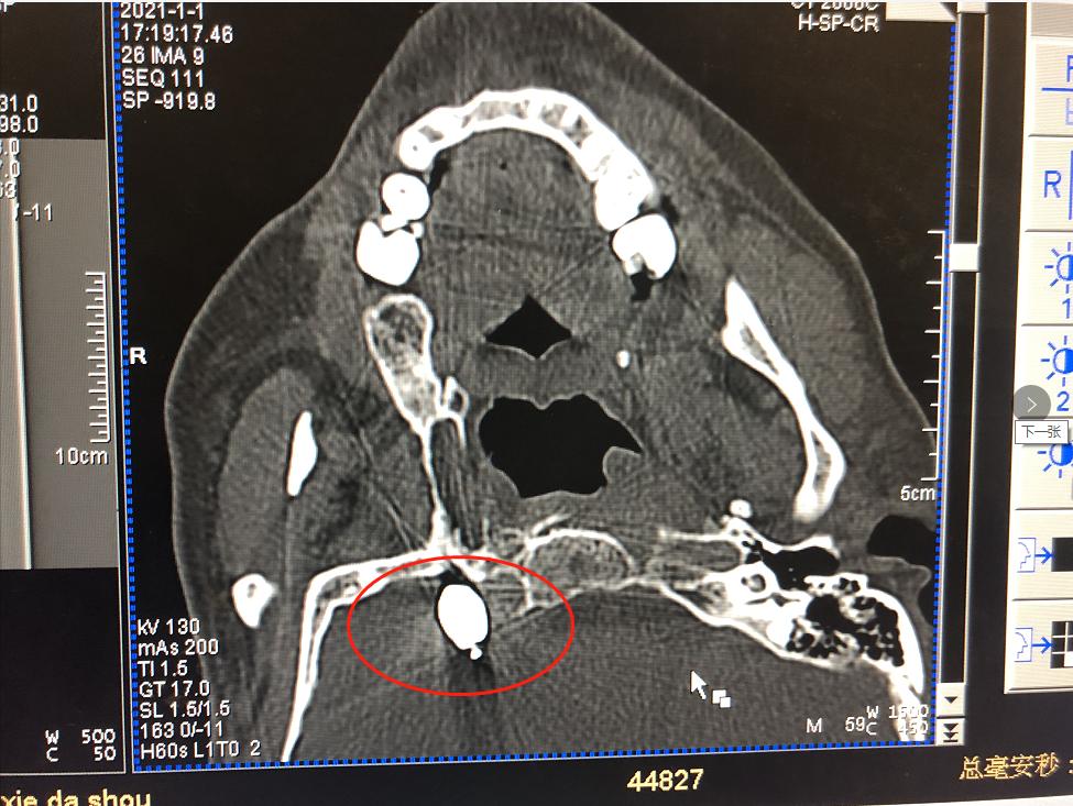 三叉神经慢性疼痛,治好了几十年的三叉神经痛