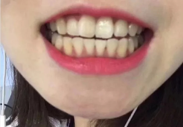 刘涛是全口瓷牙,艺人刘涛的一口烤瓷牙多少钱