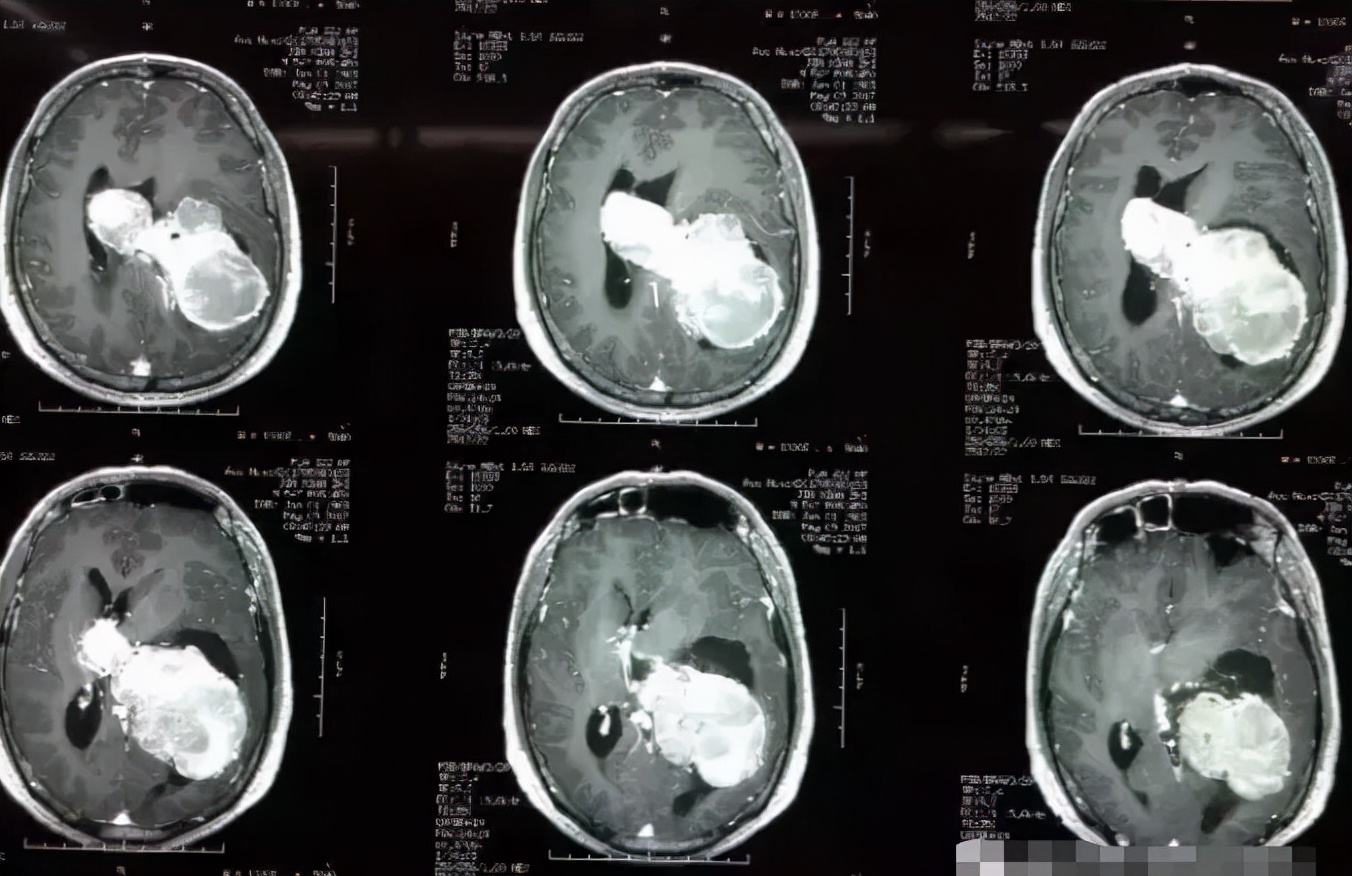 良性脑瘤一般能活多久,良性脑瘤没切干净要化疗