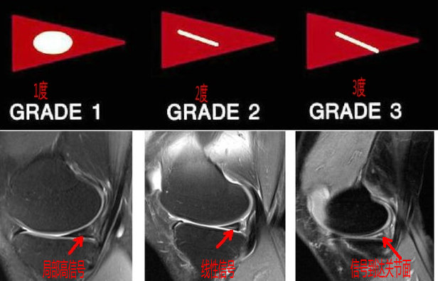 膝关节磁共振如何识别半月板损伤,磁共振半月板越来越严重怎么回事