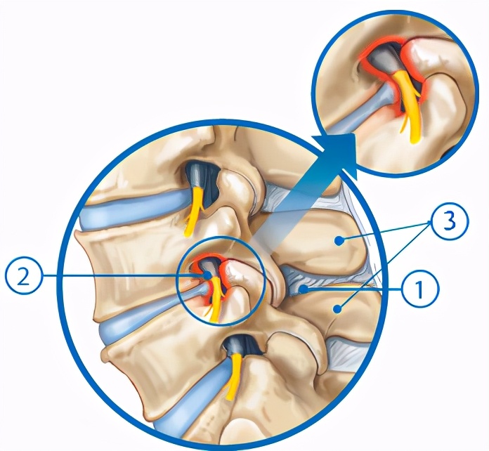 腰椎管狭窄一般能活多少年,腰椎管狭窄怎么锻炼最有效