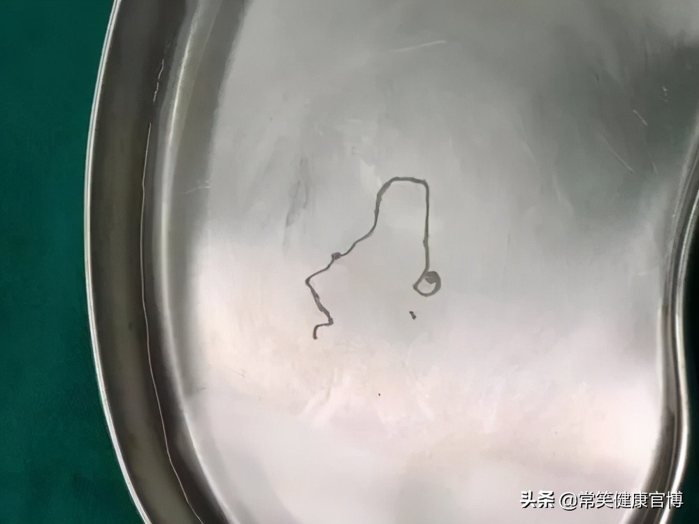 怎么知道自己感染裂头蚴寄生虫,有裂头蚴寄生虫有什么症状