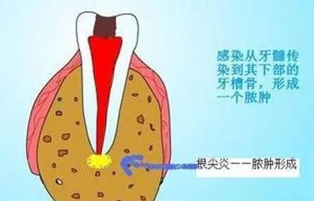 牙齿反复发炎，吃药也没用！该怎么治疗才好？
