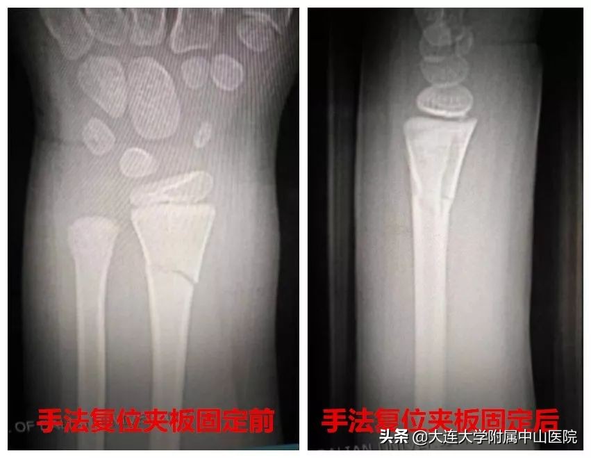 髋部骨折中西医诊疗,儿童骨损伤诊治康复