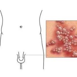 专家提醒：各种性传播疾病风险是很大的，各种部位的疱疹请关注
