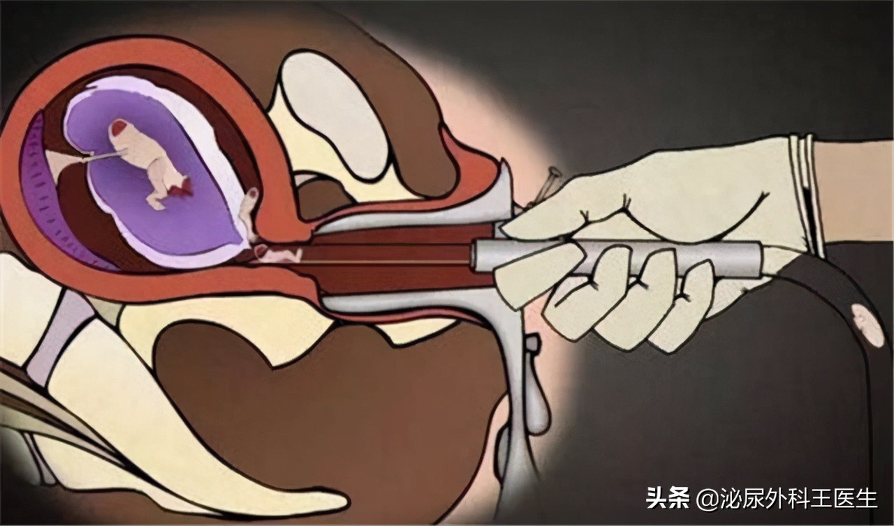 打过胎身体有哪些痕迹,女性打过胎会留下什么痕迹