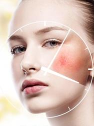 敏感肌脸上高原红怎么去掉,敏感肌高原红如何治疗