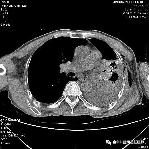 手术引起乳糜胸,有没有做了肺结节手术后是误诊的