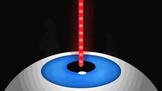 icl近视手术3d演示,icl近视手术成功经验