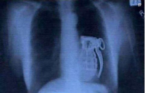 不作死就不会死,看看这些被人类搞进身体里的异物