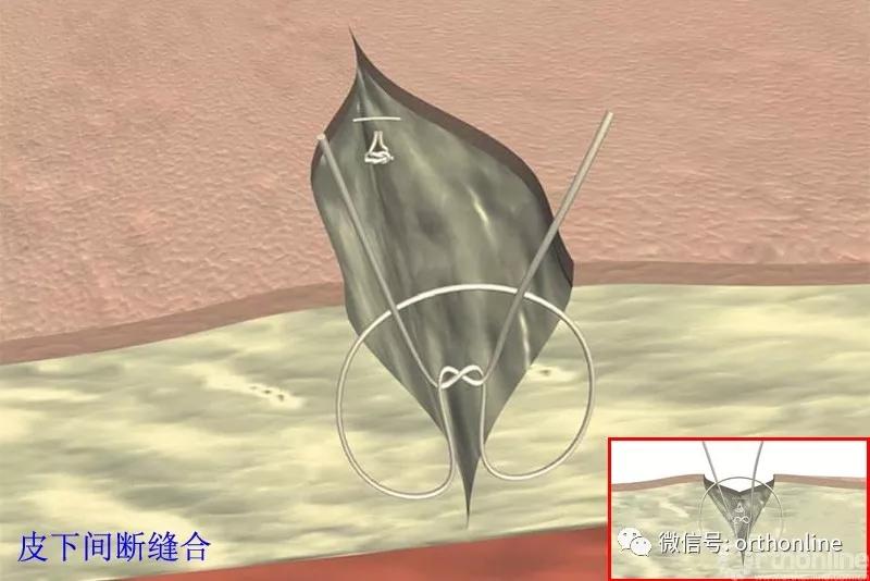 十种外科基本缝合方式详解,手术切口缝合有哪几种