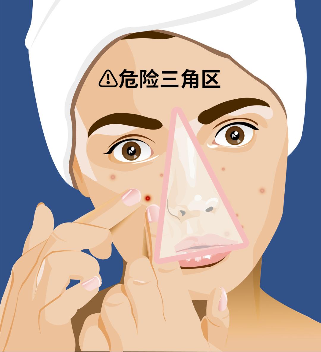 大学生挤痘痘引发的惨剧,女生挤痘痘导致面部感染