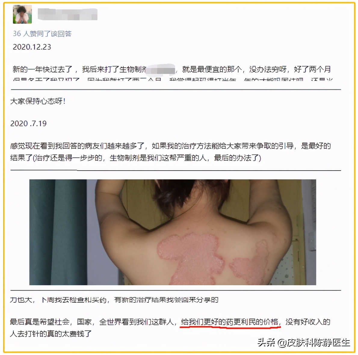 治疗牛皮癣和银屑病最好的新药,治疗银屑病最新的生物制剂