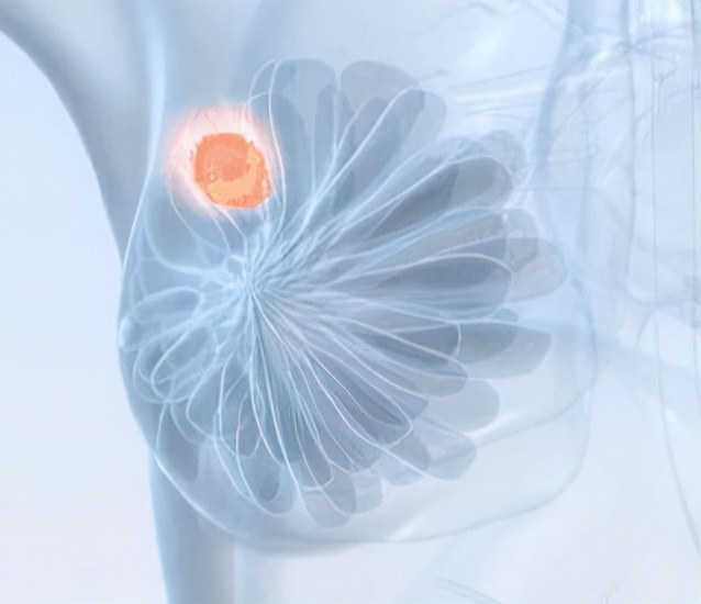 检查结果右乳低回声是怎么回事